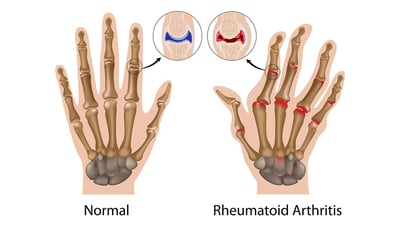 Rheumatoid Arthritis