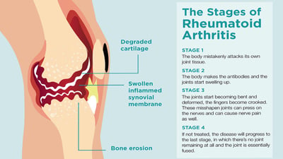Rheumatoid Arthritis