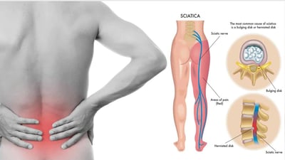 Back Pain, Sciatica