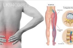 Back Pain, Sciatica