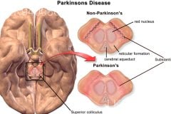 Parkinsonism Parkinsons Disease
