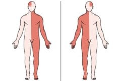 Paralysis Hemiplegia