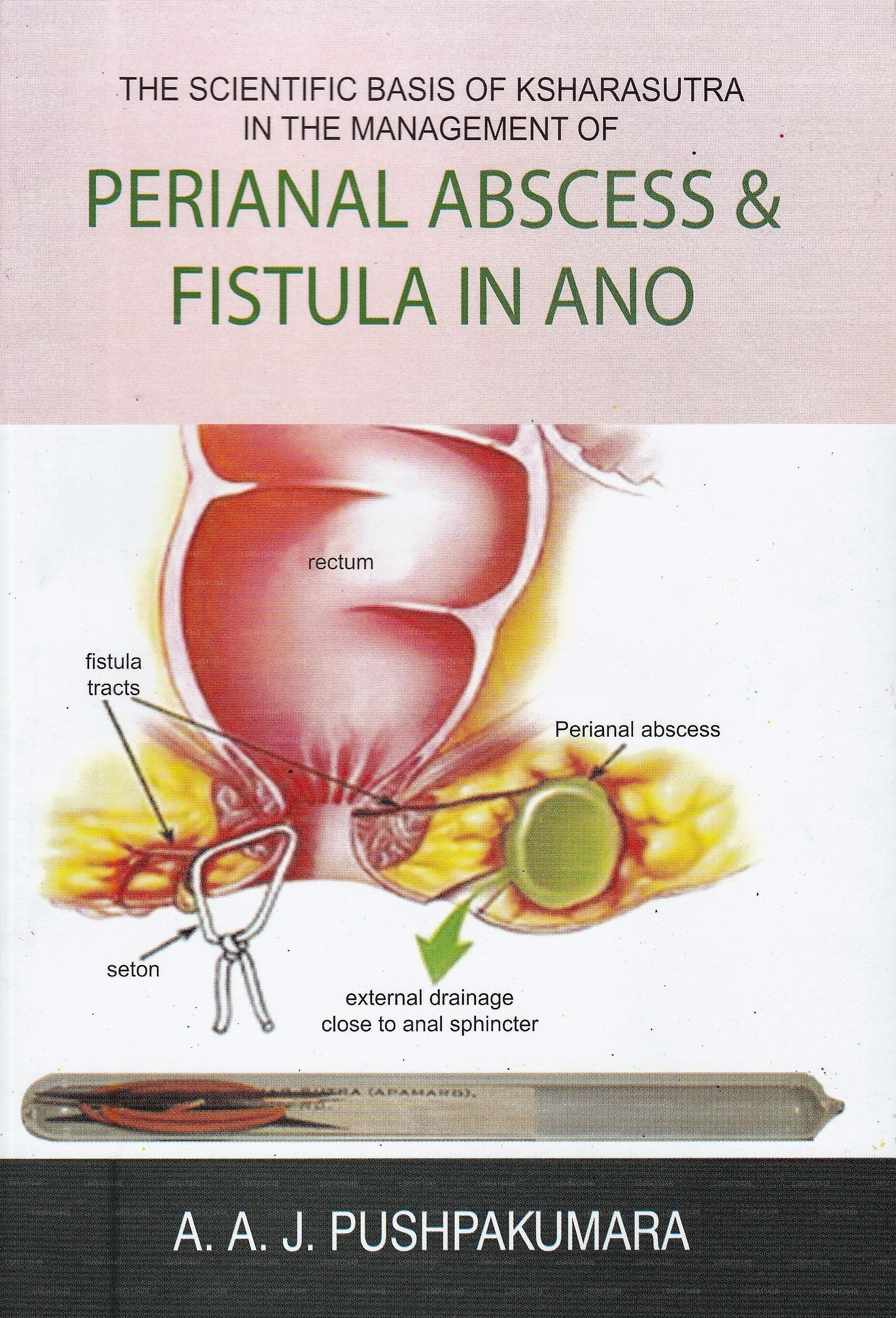 The Scientific Basis of Ksharasutra In The Managment of Perianal Abscess &Amp; Fistula In Ano